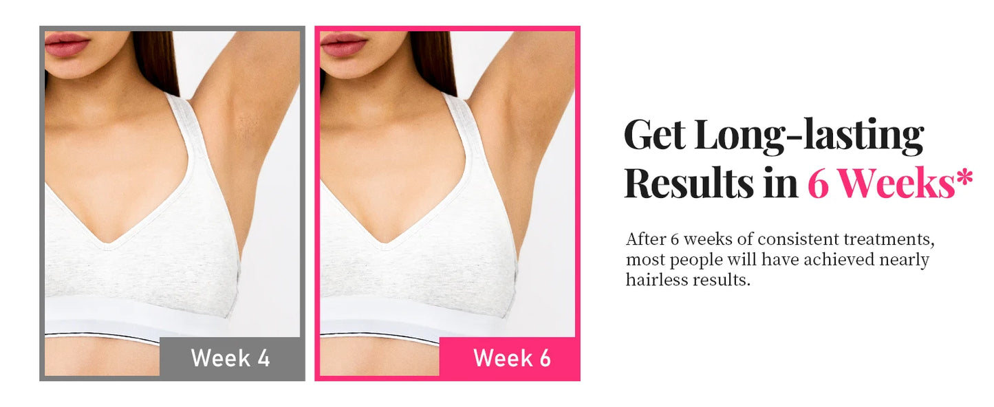 Épilateur IPL 990 000 flashs pour femmes  – épilation durable et indolore pour le corps, le bikini et le visage.