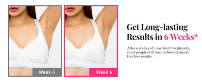 Épilateur IPL 990 000 flashs pour femmes  – épilation durable et indolore pour le corps, le bikini et le visage.