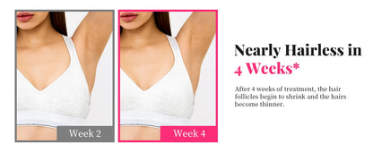 Épilateur IPL 990 000 flashs pour femmes  – épilation durable et indolore pour le corps, le bikini et le visage.